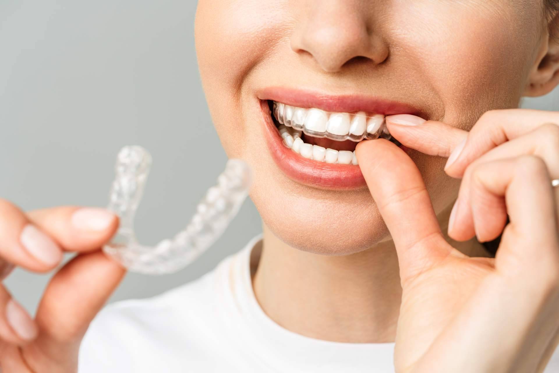 Clínica InterOralia, tratamiento Invisalign a precios competitivos y resultados excepcionales