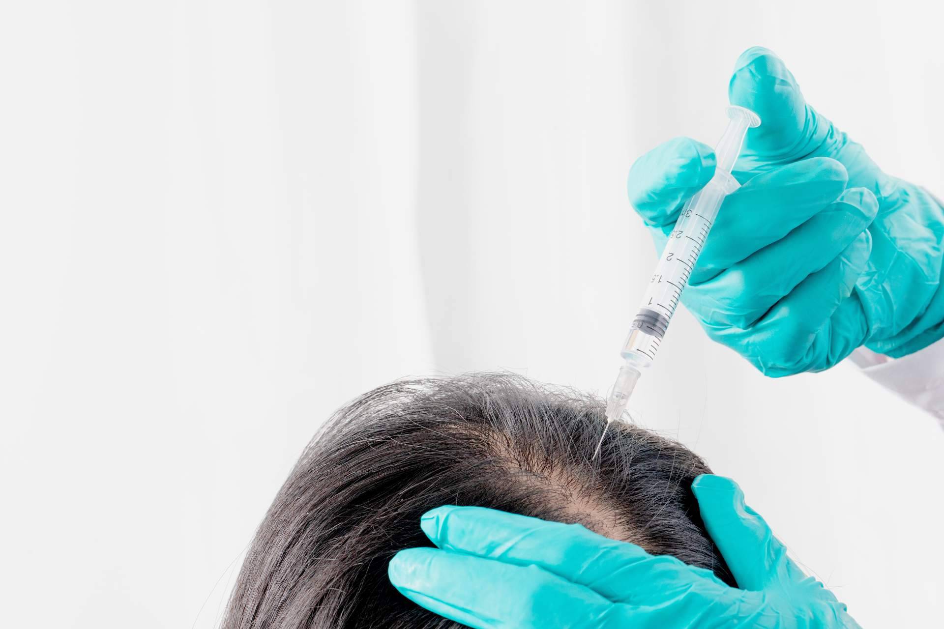 Centro Estética El Pilar estimula el crecimiento del cabello a través del tratamiento innovador PRP capilar