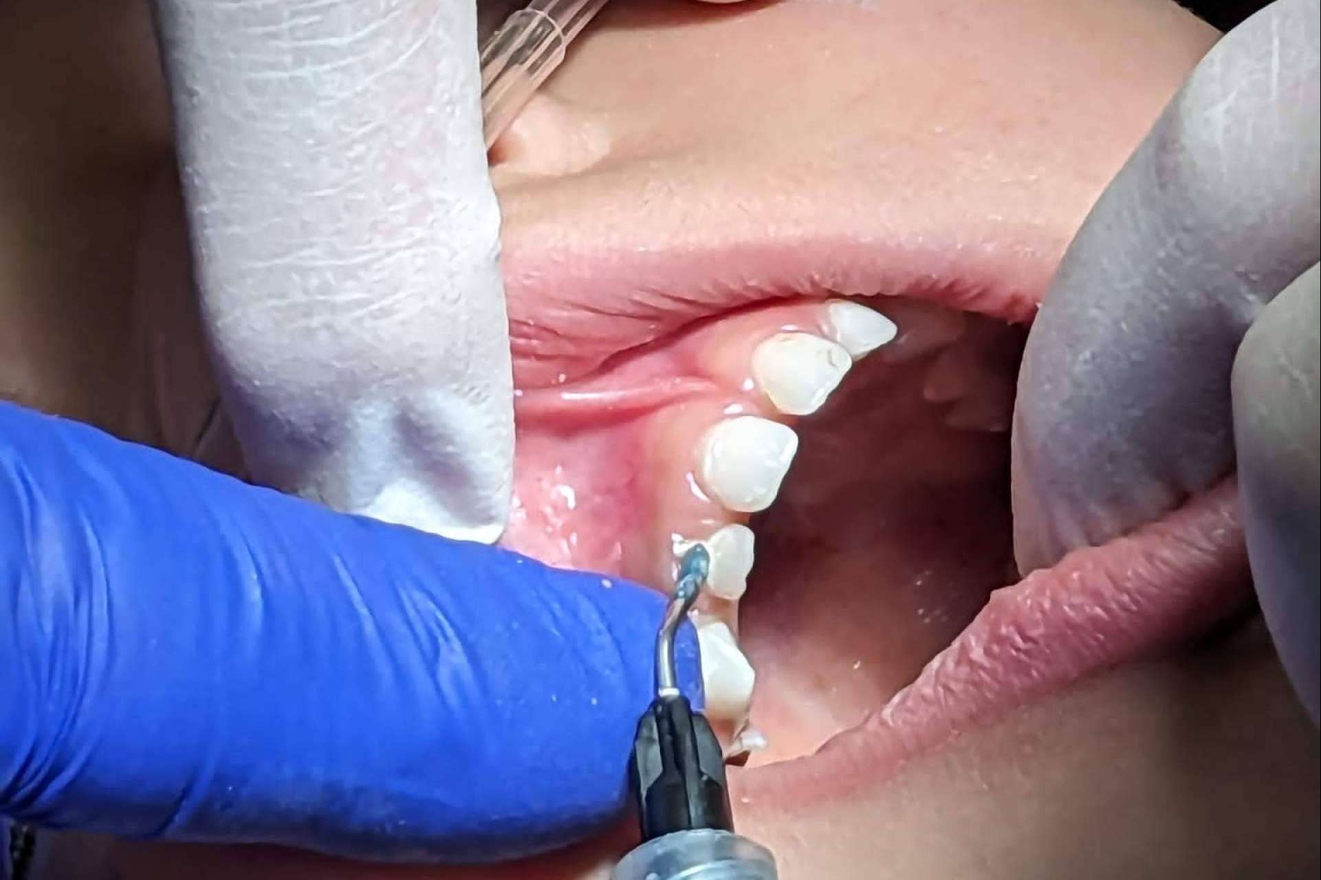 Para una experiencia sin miedo al dentista, Clínica Dental Ulman ofrece sedación consciente