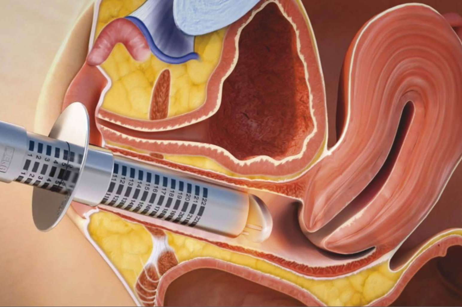 Cuáles son las secuelas del cáncer de mama de las que nadie habla