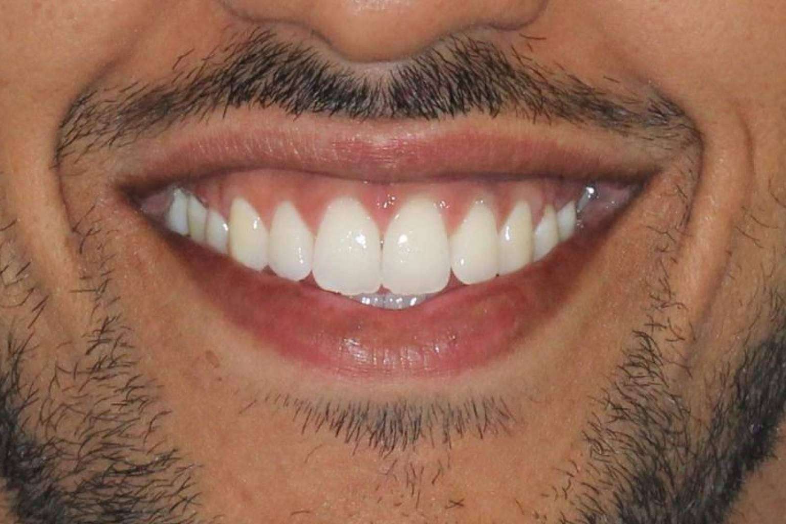 Clínica Zahara y sus servicios de blanqueamientos dentales