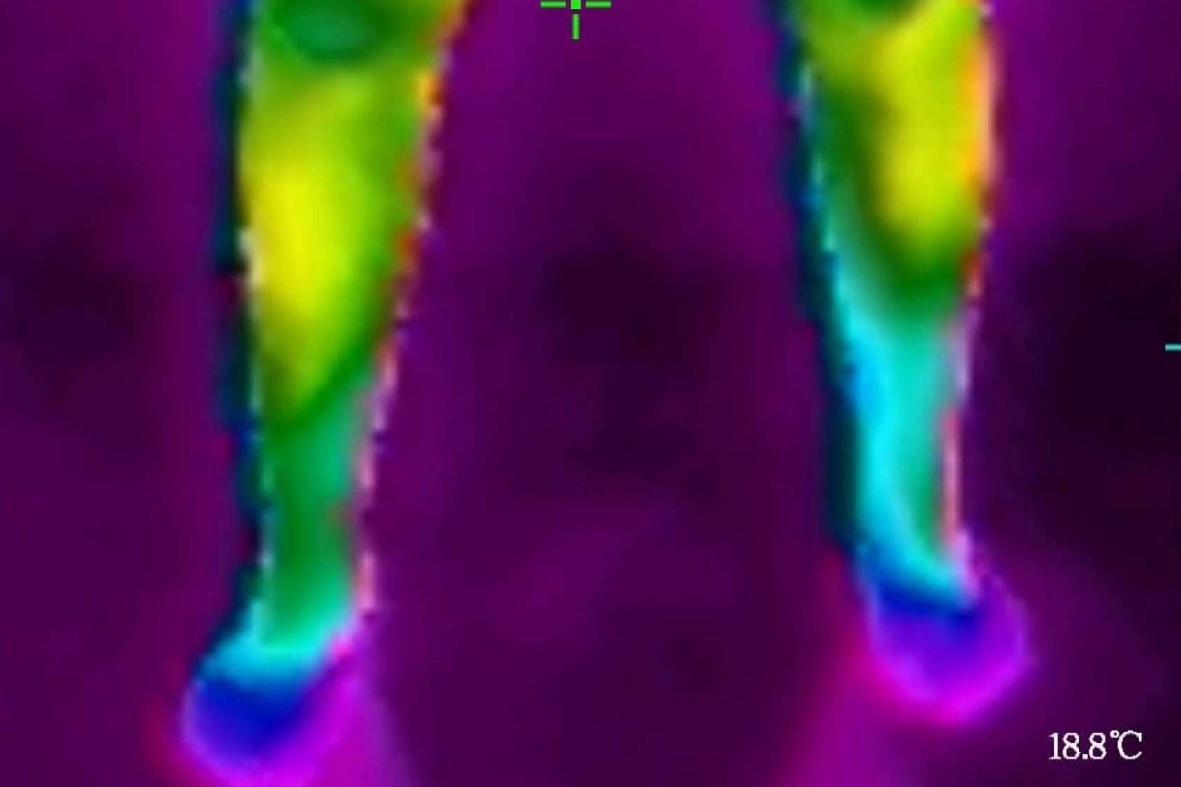 Saber cuál es el tipo de celulitis con la cámara termográfica es posible