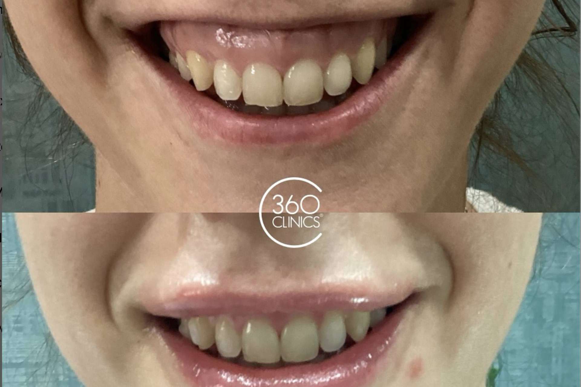 Armonizar el rostro corrigiendo la sonrisa gingival