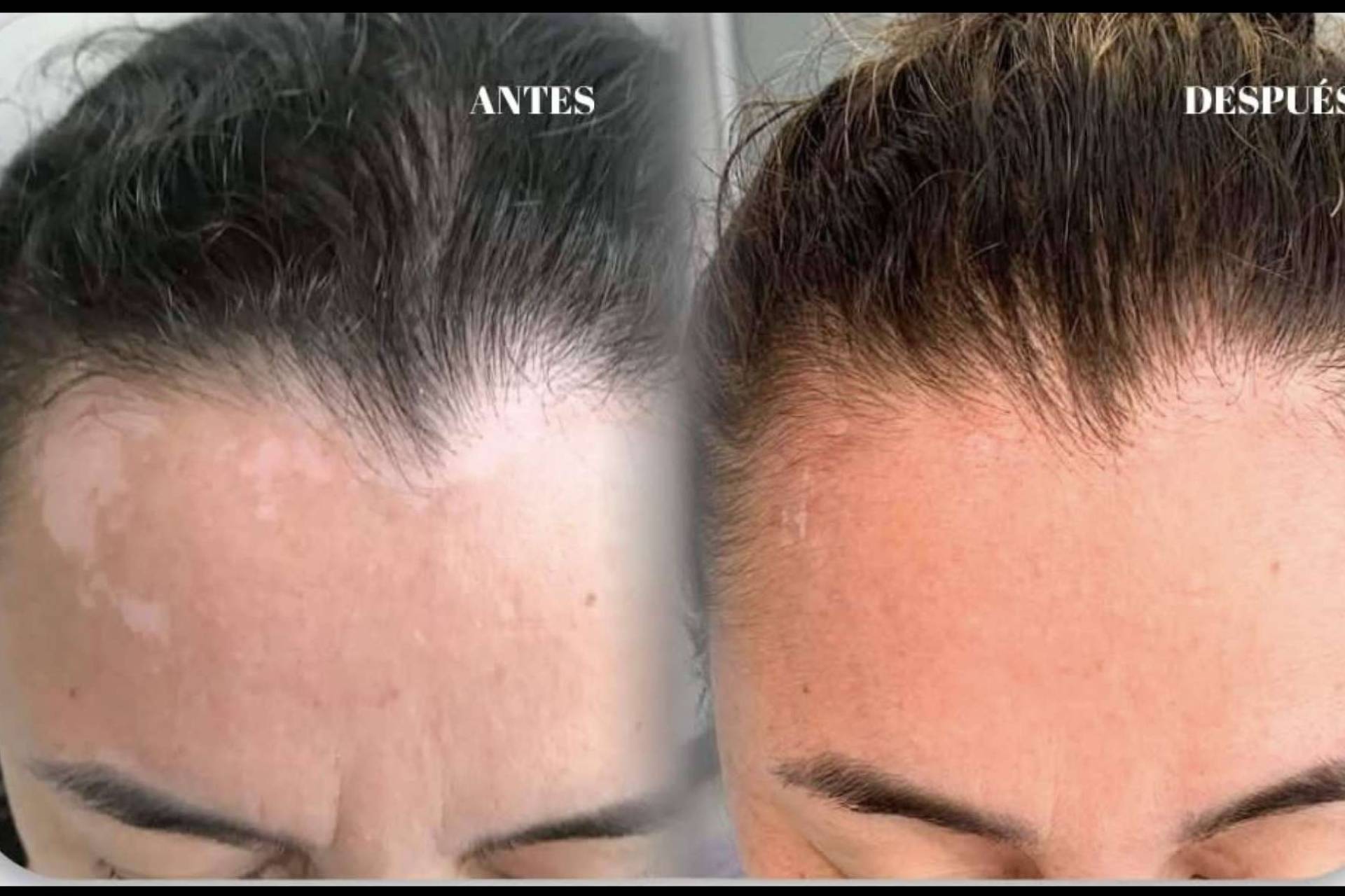 Terapia combinada para el vitiligo; el enfoque dermatológico de la Dra. Janeth Arévalo en Loja