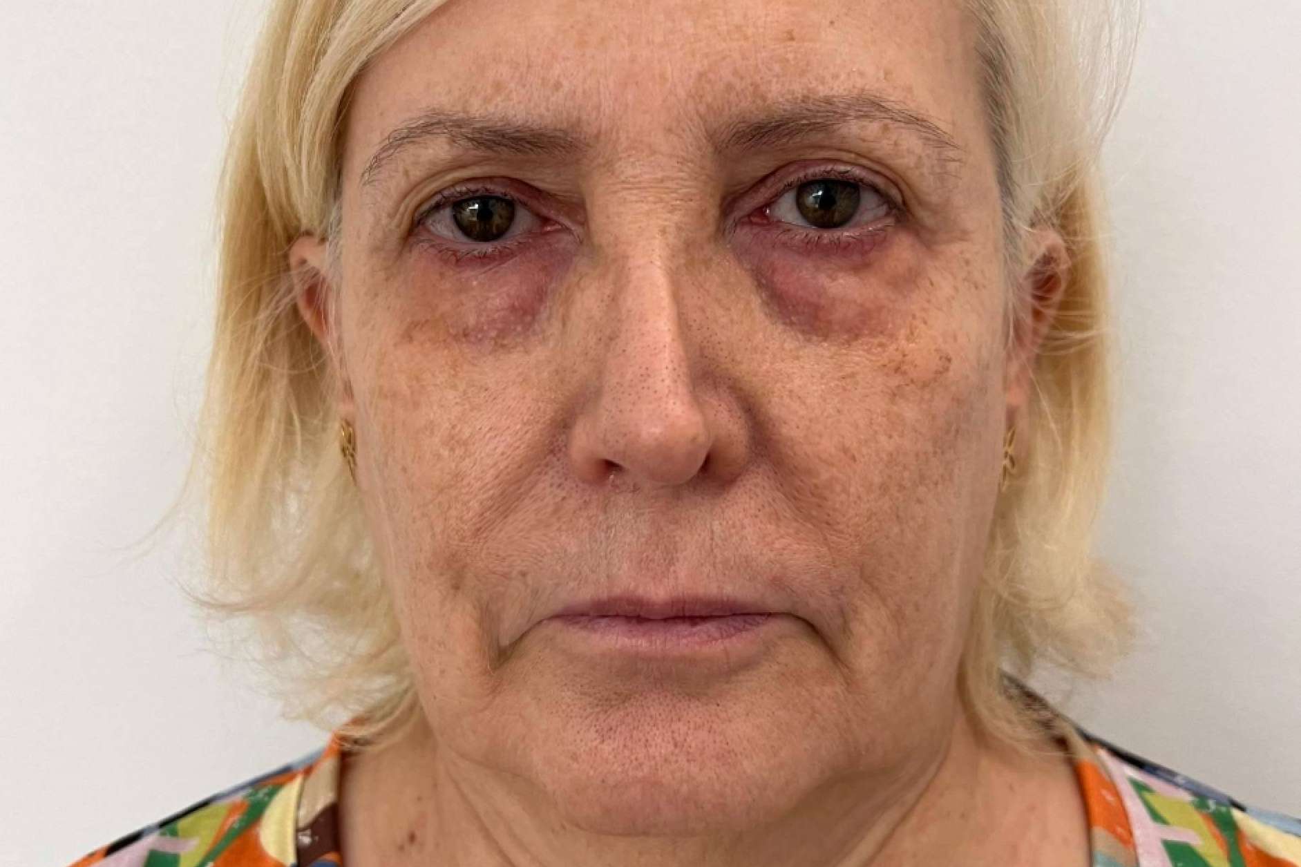 SEFFILLER®️ llega a MD Cliniques; regeneración cutánea con tejido graso propio
