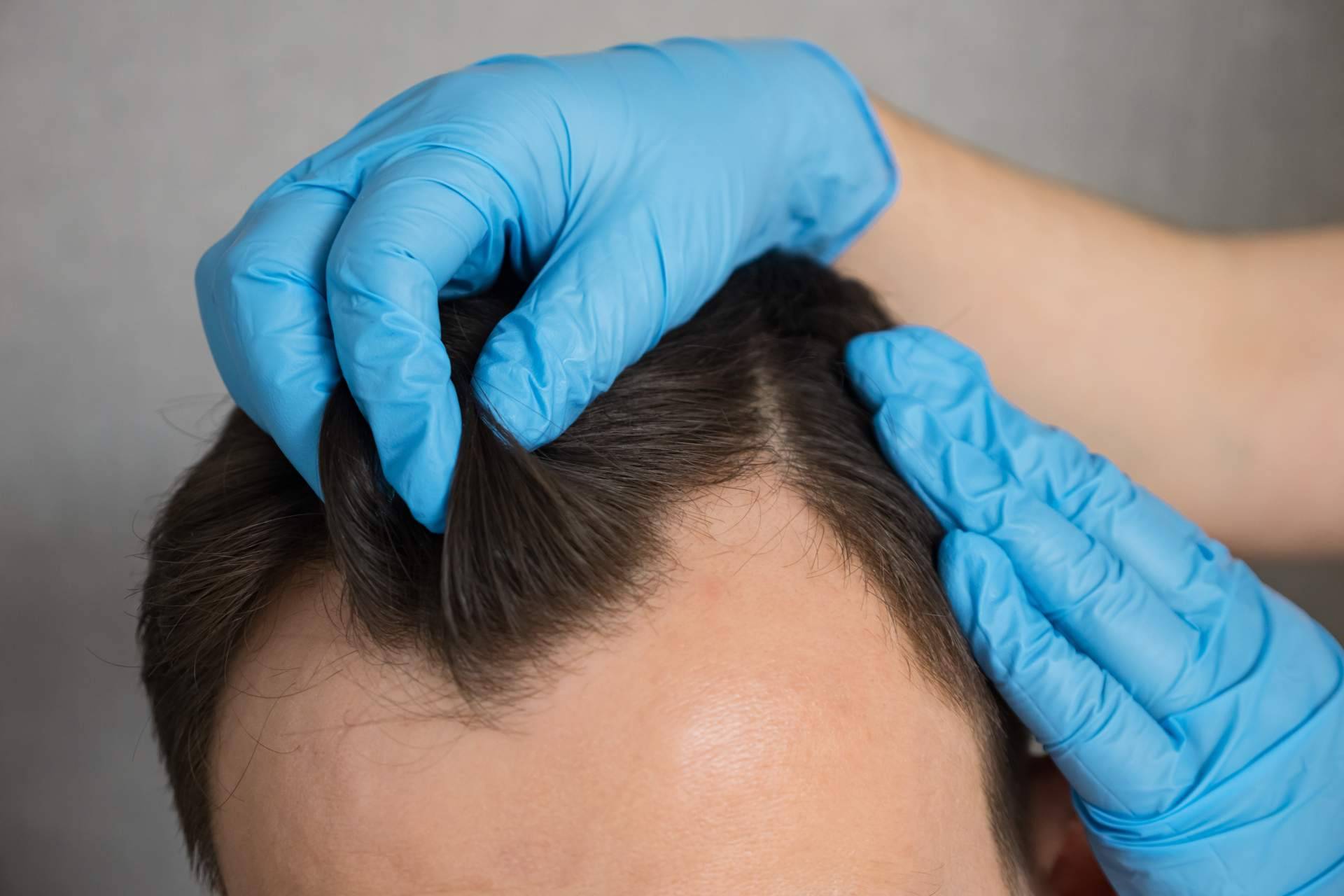 Recuperar el cabello sin pasar por quirófano; la alternativa al trasplante capilar que gana interés